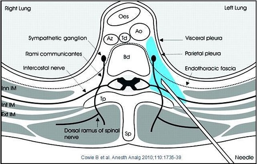 A cross-sectional view of the right lung and left lung which is located in the center of the image. The image is labeled with the names of the different parts of the lung including the sympathetic ganglion rami communicantes intercostal nerve and endothoracic fascia. <br /><br />The left lung is located on the left side of the body with the right side facing towards the viewer. The right lung is on the top left corner and the left lung on the bottom right corner.<br /><br />There are several labels on the image including "Sympathetic ganglia" "Visceral pleura" and "Parietal pleura". These labels are likely used to indicate the location of the nerves in the neck and the location where the nerves are located. The diagram also shows the dorsal ramus of the spinal nerve which can be seen in the bottom left corner of the diagram.<br />- The image also includes a needle which may be used to connect the two parts together.