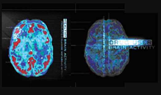 Two MRI scans of the brain one on the left side and the other on the right side. The scans are labeled "Drug User Brain Activity" and appear to be a comparison of the different areas of the human brain.<br /><br />The left scan shows the brain in red and blue colors while the right scan shows it in blue and green colors. The blue areas appear to have a more prominent area in the center of the image which is likely the location of the drug user brain activity. The image also has a label on the top right corner that reads "DRUG USER BRAIN ACTIVITY".<br /><br />Both scans are displayed on a black background and there is a text overlay on the image that explains the differences between the two scans.