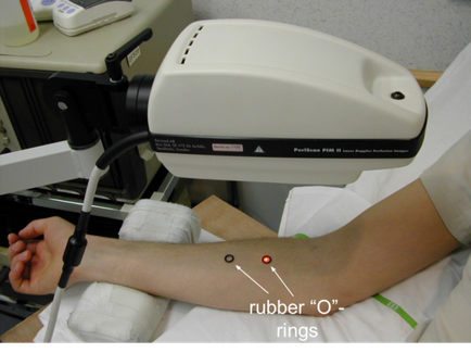 A person's arm being examined by a medical device. The device is white in color and has a label on it that reads "Rubber O" and "O" rings". The person is holding the device with their left hand and is using it to examine the person's right arm. There are two red circles on the arm one labeled "rubber" and the other labeled "rings". The device appears to be a medical examination machine as there is a white cloth draped over the arm. In the background there are other medical equipment and a monitor.