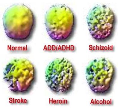 Six spherical objects arranged in a grid-like pattern. Each object has a different color - yellow pink green purple and blue. The yellow object is labeled with the words "Normal" "ADD/ADHD" "Schizoid" "Stroke" "Heroin" and "Alcohol". The green object appears to be a representation of the brain while the pink and purple objects represent the different types of neurotransmitters in the brain. The objects are labeled with their names such as "stroke" "heroin" "alcohol" and more. The background of the image is white.