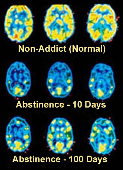 A collage of six images of the brain each representing a different aspect of the human brain. The images are arranged in a grid-like pattern with each image showing a different type of brain.<br /><br />The first image on the top left shows the brain in blue and yellow colors representing non-addict (Normal). The second image shows the same brain in yellow and blue colors. The third image shows a normal brain with a blue and green color scheme. The fourth image shows an abstract brain with yellow and red colors. <br /><br />Below the images there is text that reads "Abstinence - 10 Days" and "100 Days".