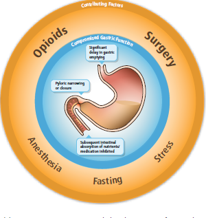 A circular diagram that shows the different types of opioids and their associated factors. The diagram is divided into three sections each representing a different type of surgery.<br /><br />The first section is labeled "Opioids" and shows a large intestine with a small intestine in the center. The intestine is surrounded by a blue circle with the words "Anesthesia" and "Fasting" written on it. The second section is titled "Surgery" and has a label that reads "Compromised Gastric Function". The third section is labeled "Stress".<br /><br />There is also a label on the right side of the diagram that says "Pyloric narrowing or decrease". This label indicates that the surgery is taking place in the digestive system which is responsible for causing pain and discomfort in the stomach. The image also has a link to a website that provides more information about the surgery and its associated factors such as "contributing factors" "anesthesia" and "fasting".