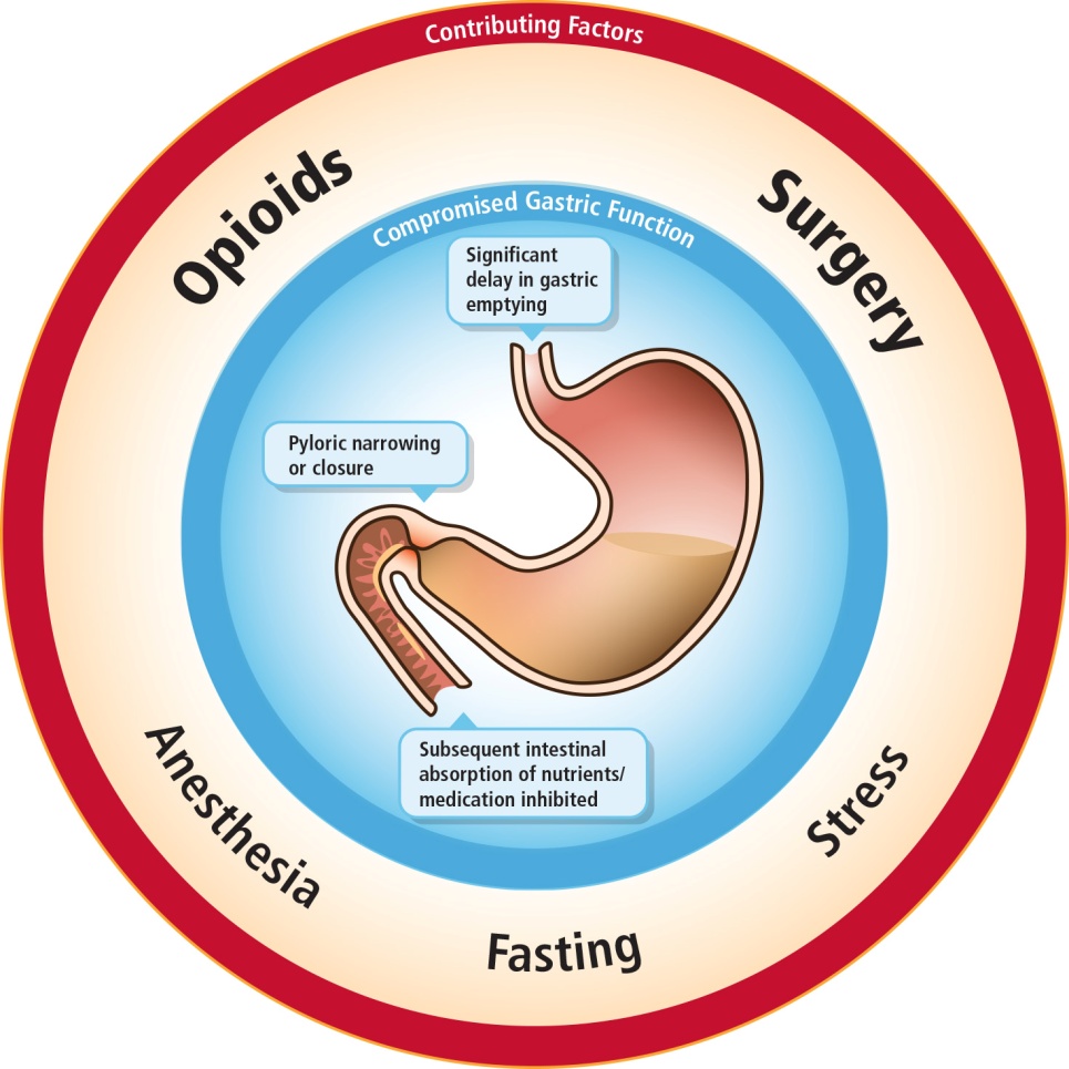 A circular diagram that shows the potential effects of opioids surgery anesthesia fasting and stress on gastric function.<br /><br />"Compromised gastric function" may be observed in "Significant delay in gastric emptying" "Pyloric narrowing or closure" "Subsequent intestinal absorption of nutrients / medication inhibited" etc.