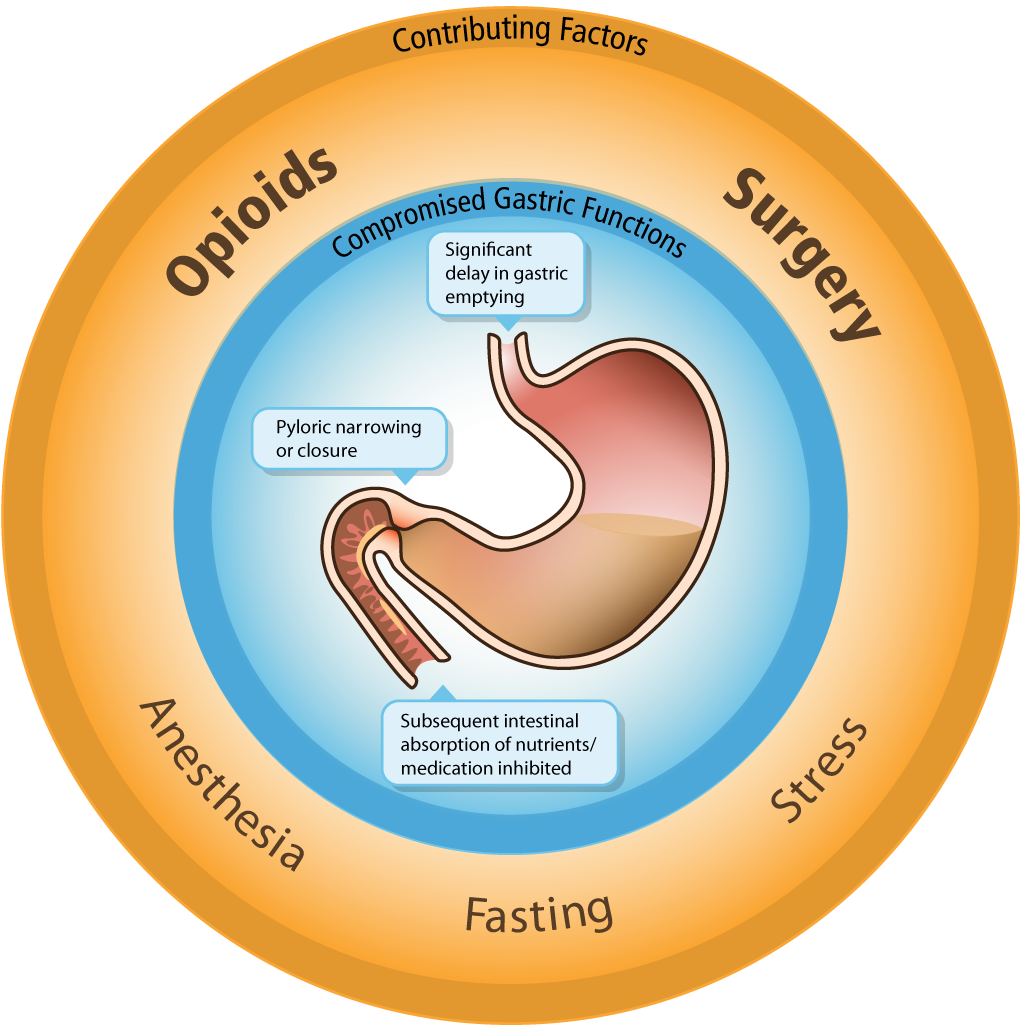 A circular diagram that shows the potential effects of opioids surgery anesthesia fasting and stress on gastric function.<br /><br />"Compromised gastric function" may be observed in "Significant delay in gastric emptying" "Pyloric narrowing or closure" "Subsequent intestinal absorption of nutrients / medication inhibited" etc.