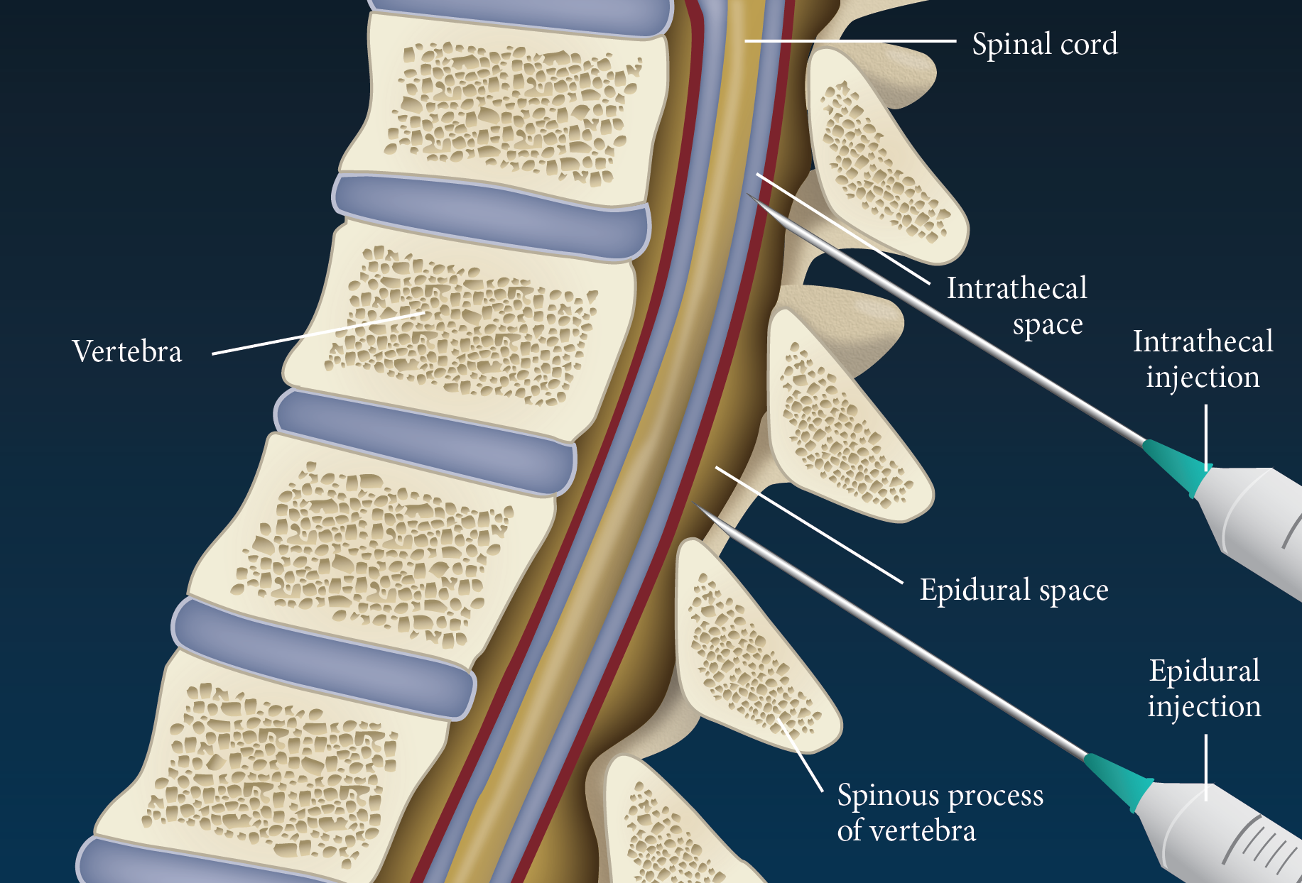 A cross-section of a vertebrae which is a part of the spinal cord. The vertebral column is shown in the center of the image with the vertebral nerves and spinal cord extending from the top to the bottom. The nerves are arranged in a radial pattern with each nerve having a different color and shape.<br /><br />On the right side of the diagram there are two syringes one labeled "Spinal cord" and the other labeled "Intraceutical injection". The syringe on the left side is used to inject the injection into the spinal nerve while the syringe in the middle is used for the injection. The injection is labeled "Epidural space" and has a needle inserted into it indicating that it is being injected into a spinal cord that is responsible for the process of the injection which involves the insertion of an epidural space into the spine. The image also shows the spines which are responsible for providing support and stability to the spinal nerves.