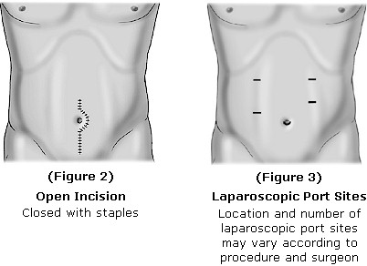 A side-by-side comparison of two images of a person's torso. On the left side there is a diagram of an open incision which is a type of surgical procedure that occurs when the person is closed with staples. The diagram shows the location and number of laparoscopic port sites may vary according to procedure and surgeon.<br /><br />On the right side of the image there are two illustrations of the same person's body one showing the open incisions and the other showing the location of the laparoscopy port sites. The open incisors are located on the left and right sides of the body and the location is marked with a small black dot. The image also includes text that explains the difference between the two images.