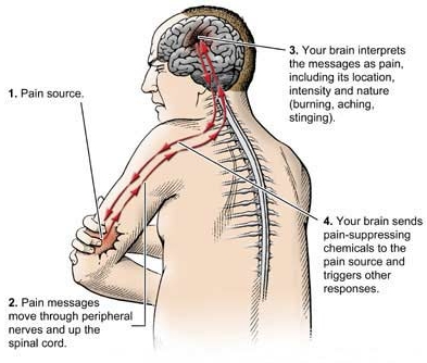 A diagram of a human body with the brain and spinal cord highlighted. The brain is shown in the center of the image with the spinal cord extending from the left side of the body to the right side. The spinal cord is red and extends from the neck to the back of the head. <br /><br />There are three bullet points on the image that explain how the brain interprets the messages as pain including its location intensity and nature (burning aching stinging). The first bullet point explains that the brain is experiencing pain through peripheral nerves and up the spinal cords. The second bullet point shows that the pain messages move through the peripheral nerve and up a spinal cord. The third bullet point mentions that your brain sends pain-suppressing chemicals to the pain source and triggers other responses.<br /><br />The image also has a label on the top right corner that reads "1. Pain source."