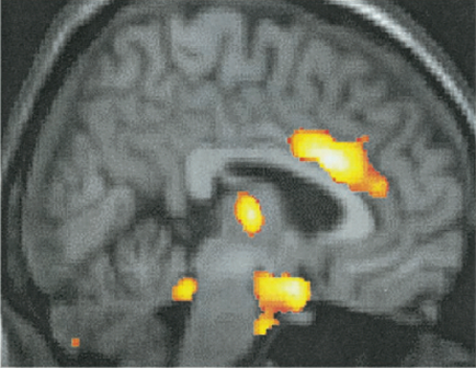 A black and white MRI scan of the brain which is a type of brain scan that shows the location of the cerebellum in the human brain. The scan is a cross-sectional view of the head and neck and the brain appears to be in the center of the image. The image is taken from a top-down perspective with the left side of the scan visible and the right side visible. There are several orange and yellow areas in the image which appear to be areas of the human head which are likely the areas where the brain is located. These areas are likely areas of brain activity such as the cerebrum cerebellums and spinal cord. The orange areas are clustered together in a circular pattern while the yellow areas are scattered throughout the image in a more prominent position. The areas are labeled with the names of the different areas and there are also some areas that are not clearly visible in the scan. - The image appears to have been taken at night as there are no other objects or structures in the background.