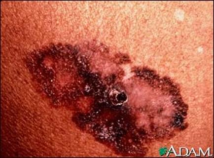 A close-up of a person's skin. The skin appears to be red and inflamed with a dark brown color. In the center of the skin there is a small oval-shaped indentation. The indentation is covered in small dark spots which appear to be inflamed. There is also a small black dot on the right side of the indentation which could be a small amount of blood or fluid. The image is taken from a slightly elevated angle looking down on the skin.