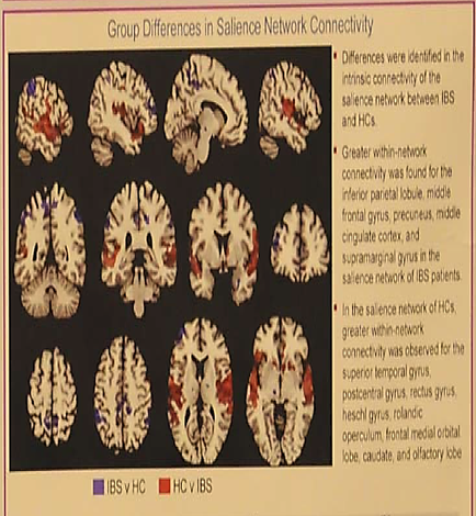 A diagram that shows the different types of salience network connectivity in the brain. It is divided into six sections each representing a different type of brain. The first section on the top left shows the cerebellum of the human brain which is the largest and most prominent feature in the image. The brain is shown in red and white representing the different areas of the brain that are affected by the salience networks. The top right section shows the greater within-network connectivity between the IBS and HCS which was found for the inferior parietal lobe middle frontal cortex middle singular cortex and superior cerebral cortex. In the center of the image there is a section titled "In the Salience Network of IBS patients greater within network connectivity was observed for the superior temporal cortex rectus gyrus hess gyrus (rectus gryus) hessii gyrus and rectus cyrus) and hessis gyrus. The image also shows the location of the cerebrospinal cord which can be seen in the top right corner of the diagram. The diagram also includes a label that explains the differences between the two types of connections. The text on the right side of the slide provides further information about the differences.