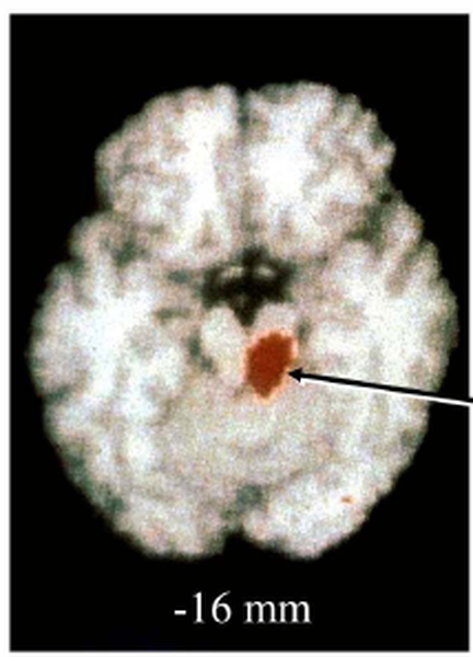 A microscopic view of a human brain. The brain appears to be white in color and has a rough texture. In the center of the image there is a small red dot which is likely the nucleus of the brain. Surrounding the red dot are several smaller black dots which may be nerves or other structures. The image is labeled with the text "16 mm" at the bottom.