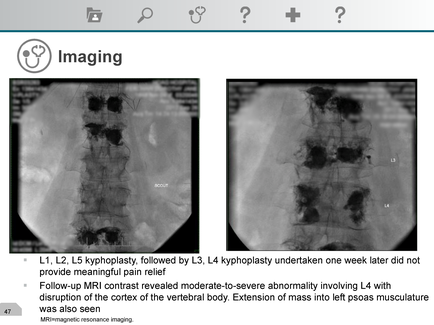 A black and white MRI scan of a patient's spine. The scan is divided into two sections with the left side showing the left and right side of the image. The left side shows the spine of the patient which appears to be in pain with a large amount of blood vessels visible. The blood vessels are arranged in a circular pattern with some areas appearing darker and others appearing lighter. The right side shows a larger area of the spinal cord which is visible in the center of the scan. The image is labeled with the text "L1 L2 L3 L4 L5 L6 L7 L8 L9 L10 L11 L12 L13 L14 L15 L16 L17 L18 L19 L20 L21 L22 L23 L24 L25 L26 L27 L28 L29 L30 L31 L32 L33 L34 L35 L36 L37 L38 L39 L40 L41 L42 L43 L44 L45 L46 L47 L48 L50 L51 L52 L53 L54 L55 L56 L57 L58 L59 L60 L61 L62 L63 L64 L65 L66 L67 L68 L69 L70 L71 L72 L73 L74 L75 L76 L77 L78 L79 L80 L81 L82 L83 L84 L85 L86 L87 L88 L89 L90 L91 L92 L93 L94 L95 L96 L97 L98 L99 L100 L110 L102 L103 L104 L105 L106 L107 L112 L113 L114 L115 L126 L127 L128 L129 L130 L131 L132 L133 L134 L135 L136 L137 L138 L139 L140 L150 L170 L175 L176 L190 L200 L220 L230 L225 L250 L260 L270 L300 L350 L400 L450 L500 L550 L600 L650 L700 L750 L800 L900 L1000 L1200 L1500 L1600 L1800 L1900 L2000 L2200 L3000 L4000 L5000 L6000 L8000 L10000