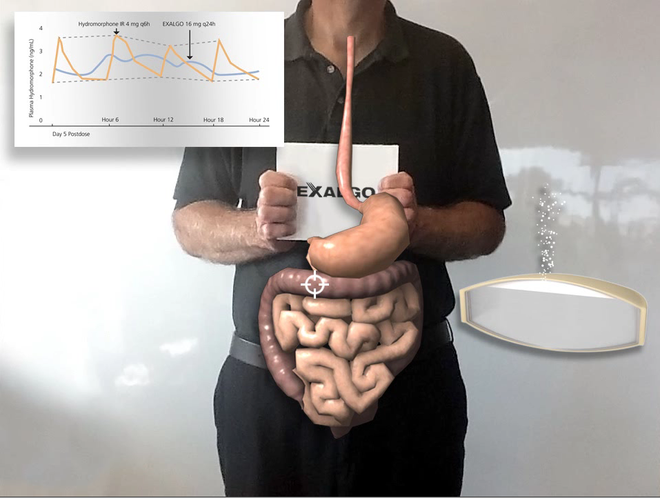 A man holding a sign that says Exalgo with a diagram of the human digestive system superimposed over his body. A run chart compares the plasma hydromorphone levels of a theoretical pain patient on Day 5 Postdose that has been prescribed Hydromorphone IR vs prescription Exalgo. There is also a computer drawing of an Exalgo pill demonstrating its extended release properties. The background is white and grey with graphic elements in orange and blue and text in black.