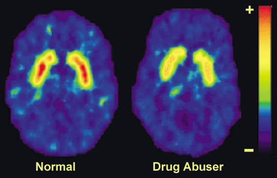 Two MRI scans of the brain one labeled "Normal" and the other labeled "Drug Abuser". The scans are shown in blue and yellow colors with the normal scan on the left and the drug abuser on the right. The normal scan shows the brain in red and yellow while the drug abuser scan shows in green and yellow. The background of the scans is black and there is a bar graph on the top right corner of the image that shows the percentage of drug abuse in the brain.