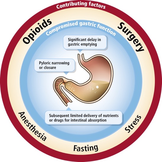 A circular diagram that shows the different types of opioids and their associated factors. The diagram is divided into three sections each representing a different factor.<br /><br />The first section is labeled "Opioids" and shows a large intestine with a small amount of blood flowing through it. The second section is titled "Surgery" and has a label that reads "Significant delay in gastric emptying". The third section is labeled "Pyloric narrowing or closure". The label also mentions that the digestive system is responsible for supplying limited delivery of nutrients or drugs for intestinal absorption. The fourth section has labeled "Anesthesia" and "Fasting".<br /><br />Overall the diagram illustrates the various factors that contribute to the overall health and well-being of the human body.