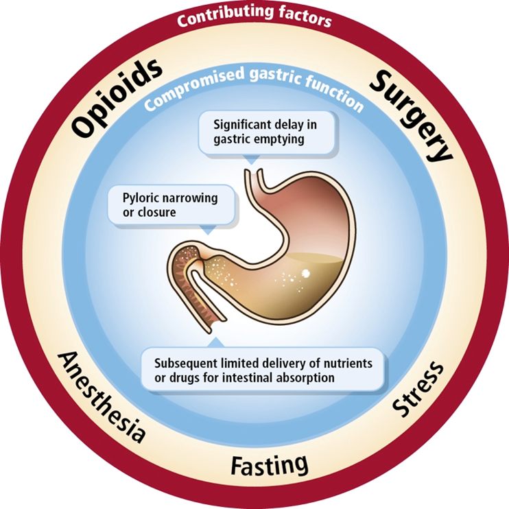 A circular diagram that shows the different types of opioids and their contributing factors. The diagram is divided into three sections each representing a different type of surgery.<br /><br />The first section is labeled "Opioids" and shows a diagram of the stomach. The second section is titled "Compromised gastric function" and has a label that reads "Significant delay in gastric emptying". The third section is labeled "Pyloric narrowing or closure". The diagram also shows a section labeled "Anesthesia" and "Subsequent limited delivery of nutrients or drugs for intestinal absorption".<br /><br />There is also a label on the right side of the diagram that says "Stress". This indicates that the image is related to the process of fasting and the contributing factors that contribute to the surgery.