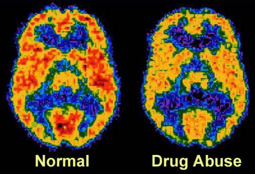 Two brain scans side by side one labeled "Normal" and the other labeled "Drug Abuse". Both scans are color-coded with the normal scan on the left and the drug abuse on the right.<br /><br />Each brain scan shows a large yellow area around the perimeter with a blue area in the center. The normal scan shows a large amount of red mixed into the yellow area whereas the drug abuse scan has very little red in comparison. The background of both scans is black making the colors of the scans stand out.