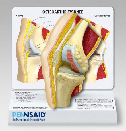 A medical illustration of the osteoarthritis knee. It is a cross-section of the knee showing the bones and ligaments. The image is labeled with the word "Pennsaid" at the bottom indicating that it is a product from the brand Pennsaid.<br /><br />The image shows the knee in a normal position with the bones on the left side of the image and the ligaments on the right side. The bones are shown in red and yellow colors with some areas of the bones appearing red and others in yellow. The ligaments appear to be inflamed and inflamed and there is a small amount of blood vessels visible in the image. The illustration is accompanied by text that explains the different types of osteoarthritis and how they can be used to treat them.