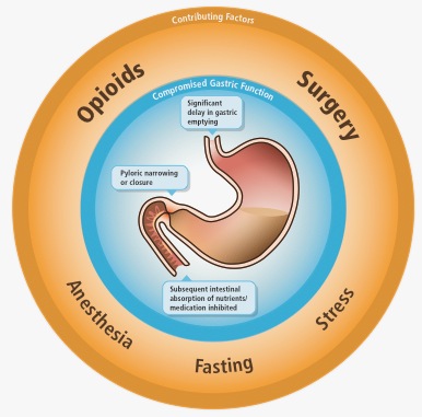 A circular diagram that shows the different types of opioids and their associated factors. The diagram is divided into three sections each representing a different type of surgery.<br /><br />The first section is labeled "Opioids" and shows a large intestine with a small amount of blood flowing through it. The second section is titled "Anesthesia" and has a label that reads "Fasting". The third section is labeled "Surgery" and is labeled as "Stress".<br /><br />There are also three factors listed in the diagram:<br /><br />- Compromised Gastric Function<br />- Significant delay in gastric dysfunction<br />- Pyloric narrowing or closure<br />- Subsequent intestinal absorption of nutrients<br />- Medication inhibited<br />- Fasting<br /><br />Overall the diagram illustrates the various factors that contribute to the overall health and well-being of the human body.