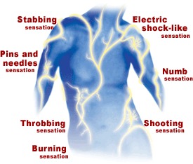 A diagram of the back of a person's body showing the different types of electrical shock-like sensation. The image is divided into three sections each representing a different type of sensation.<br /><br />The first section is labeled "Stabbing sensation" and shows a person with their back facing the viewer. The person is shown with their arms stretched out to the sides and their head tilted slightly to the side. The second section is titled "Electric shock-Like sensation" with a yellow lightning bolt in the center. The lightning bolt is surrounded by red and yellow lines representing the electrical shock. The third section is labeled "Pins and needles sensation" which shows the person's nerves and nerves. The fourth section is called "Throbbing sensation" which shows that the person is experiencing a burning sensation. <br /><br />Overall the image conveys the idea that electric shock can be caused by a variety of factors such as stabbing pins needles and numb sensation.