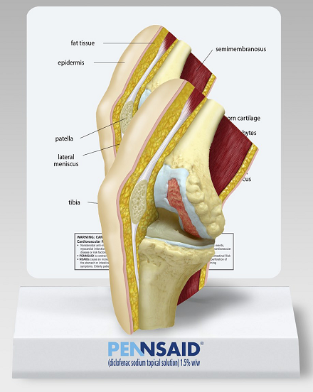 A 3D model of a human knee joint specifically the femur. The model is displayed on a white pedestal with the word "PENSSAID" written in blue at the bottom. The knee joint is shown in a cross-section with the bones and ligaments clearly visible.<br /><br />The femur is divided into two sections the top section is labeled "fat tissue" and the bottom section is labeled "epidermis". The fat tissue is located on the left side of the knee while the epidermis is on the right side. The femur has a red and yellow striped pattern on the top and bottom of the image indicating that it is a femur with a semimembranosus which is a type of bone that is responsible for the formation of bones in the knee joint. The bone is also labeled with the names of the bones such as "patella" "lateral meniscus" and "tibia".<br /><br />There is also a label on the bottom right corner that reads "diaphragm sodium topical solution 1.5% ww".