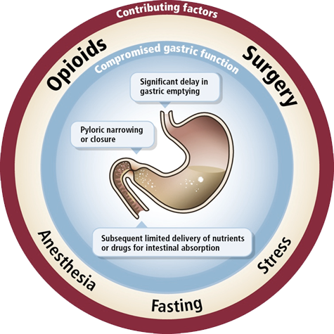 A circular diagram that shows the different types of opioids and their associated factors. The diagram is divided into three sections each representing a different factor.<br /><br />The first section is labeled "Opioids" and shows a diagram of the stomach. The second section is titled "Compromised gastric function" and has a label that reads "Significant delay in gastric emptying". The third section is labeled "Pyloric narrowing or closure". The diagram also shows that the digestive system is responsible for supplying limited delivery of nutrients or drugs for intestinal absorption. The fourth section is called "Anesthesia" and is labeled as "Fasting".<br /><br />Overall the diagram illustrates the various factors that contribute to the overall health and well-being of the human body such as the presence of opioids the ability to reduce inflammation and the potential for stress.