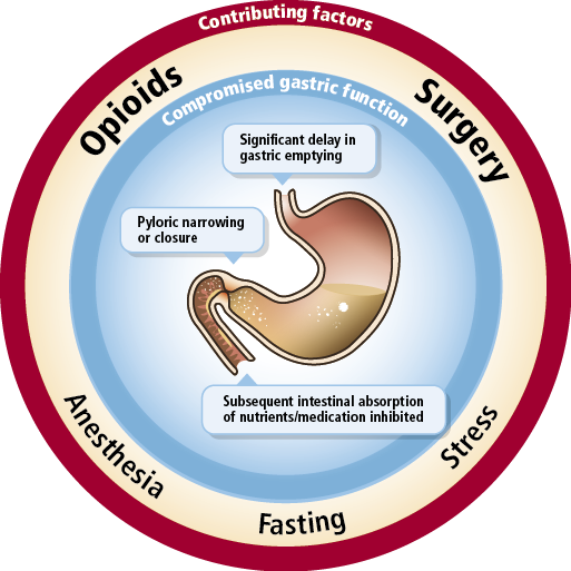 A circular diagram that shows the different types of opioids and their associated factors. The diagram is divided into three sections each representing a different factor.<br /><br />The first section is labeled "Opioids" and shows a large intestine with a small amount of blood flowing through it. The second section is titled "Surgery" and has a label that reads "Significant delay in gastric emptying". The third section is labeled "Pyloric narrowing or closure".<br /><br />There are also labels that say "Anesthesia" "Subsequent intestinal absorption of nutrients/medication inhibited" and "Stress". These labels indicate that the image is related to the process of fasting which is a type of digestive disorder that affects the digestive system. The image also has a red border around the edges which further emphasizes the importance of the factors in the diagram.