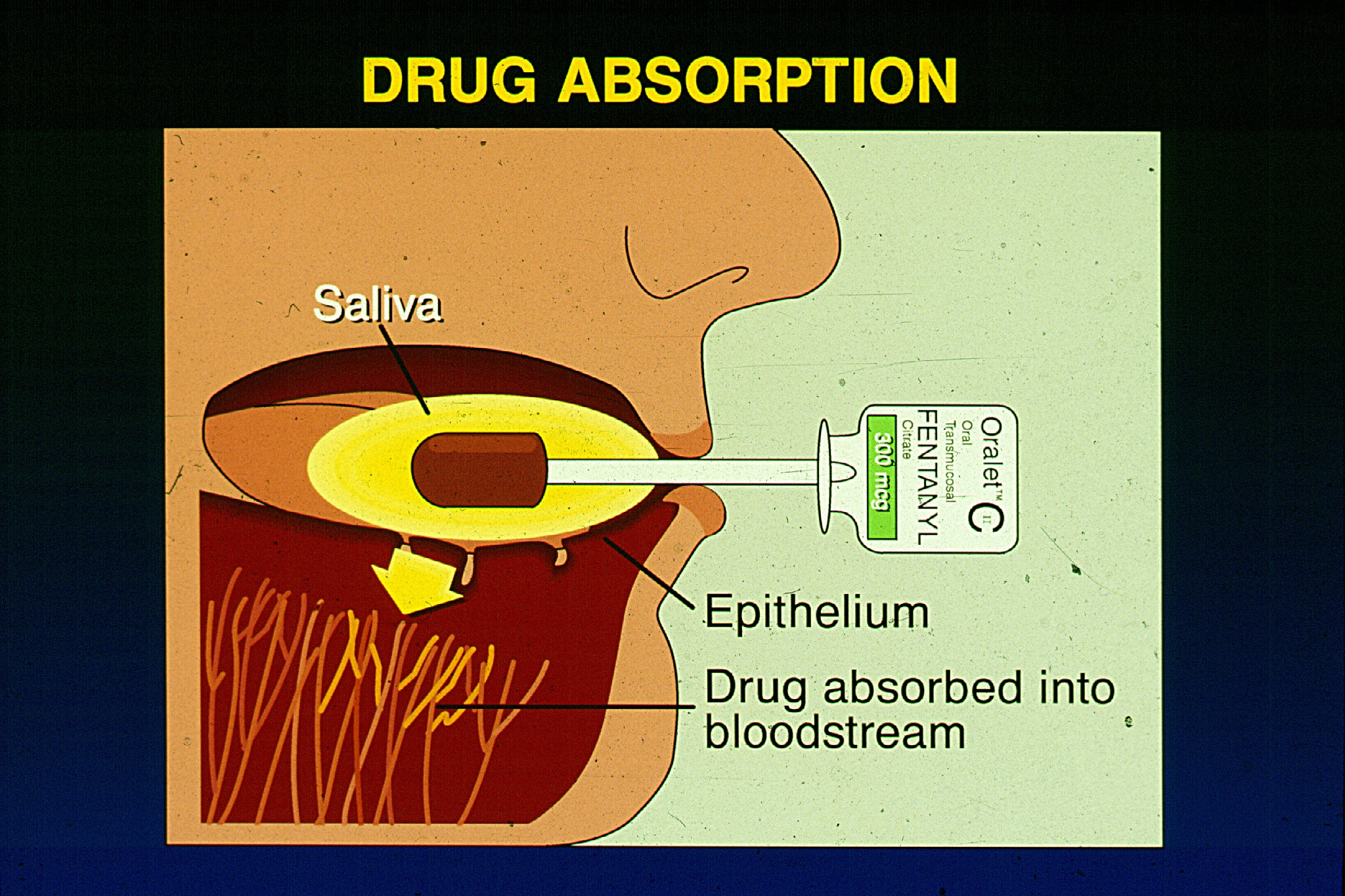 An illustration of a person's mouth with a syringe inserted into it. The syringe is labeled with the word "Drug Absorption" at the top. Below the syringe there is a label that reads "Saliva" and "Epithelium". <br /><br />The image also shows the inside of the mouth which is filled with saliva. The saliva is a yellowish-orange color and appears to be floating in the air. There is also a small amount of blood flowing through the mouth.<br /><br />On the right side of the image there are two labels that read "Drug absorbed into bloodstream" and a label on the bottom right corner that says "Oral-C". This indicates that the image is related to the process of drug absorption.