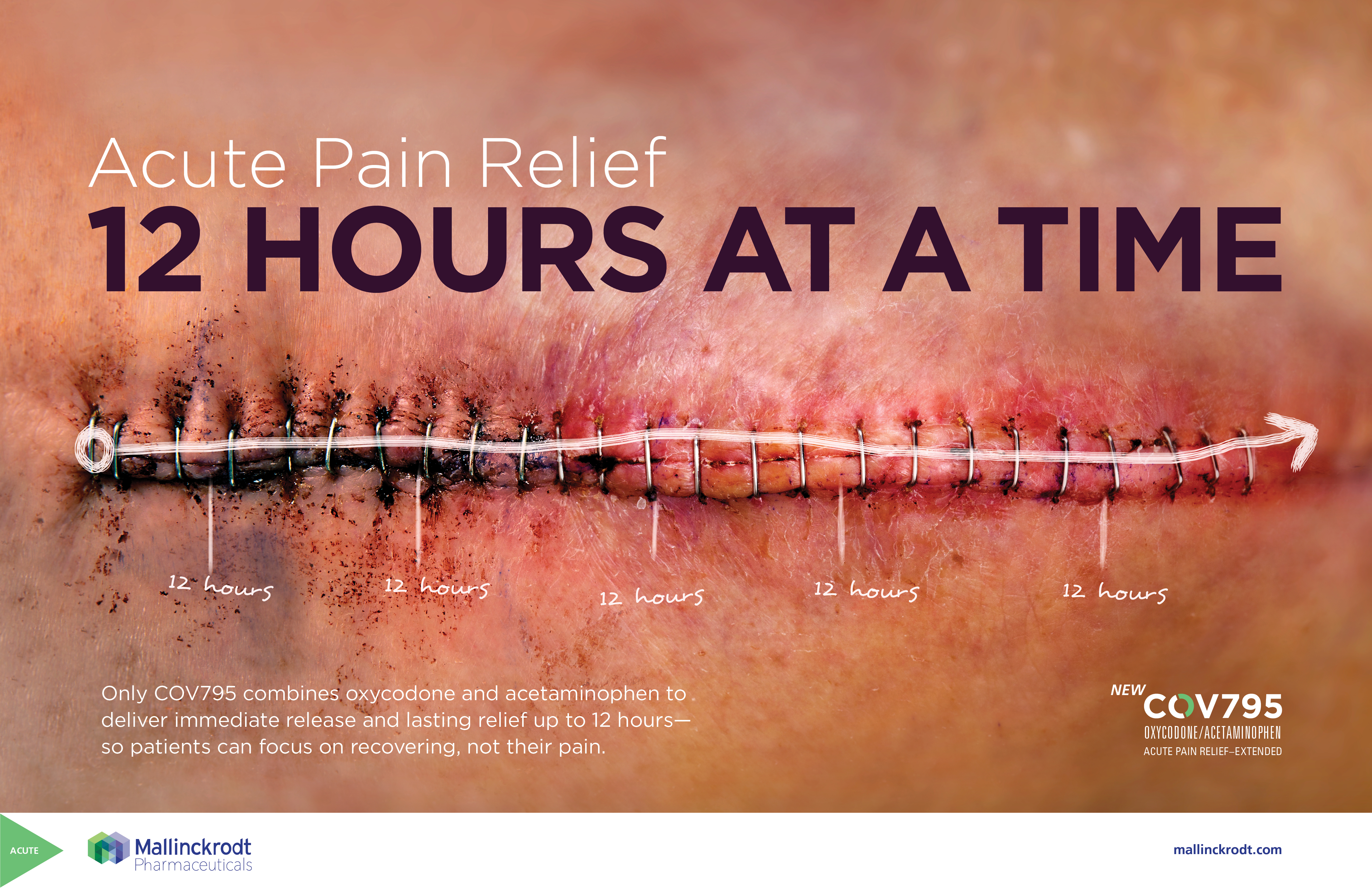 An advertisement for Acute Pain Relief at a time. It has a close-up of a person's skin with a wound on it. The wound appears to be a scar or a wound  with multiple stitches and stitches visible. The stitches are arranged in a diagonal line with the stitches on the left side of the image and the stitches in the middle. The background is orange and there is text on the top and bottom of the advertisement that reads "Acute pain relief 12 hours at a-time". The text also mentions that only COV795 combines oxycodone and acetaminophen to deliver immediate release and lasting relief to 12 hours so patients can focus on recovering not their pain.